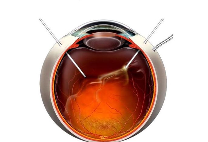 Vitrectomia – cirurgia para restaurar a visão